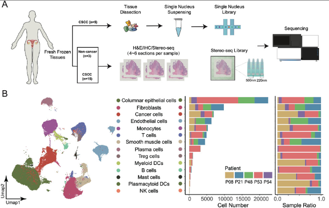 Spatial transcriptomic profile of cervical squamous cell carcinoma