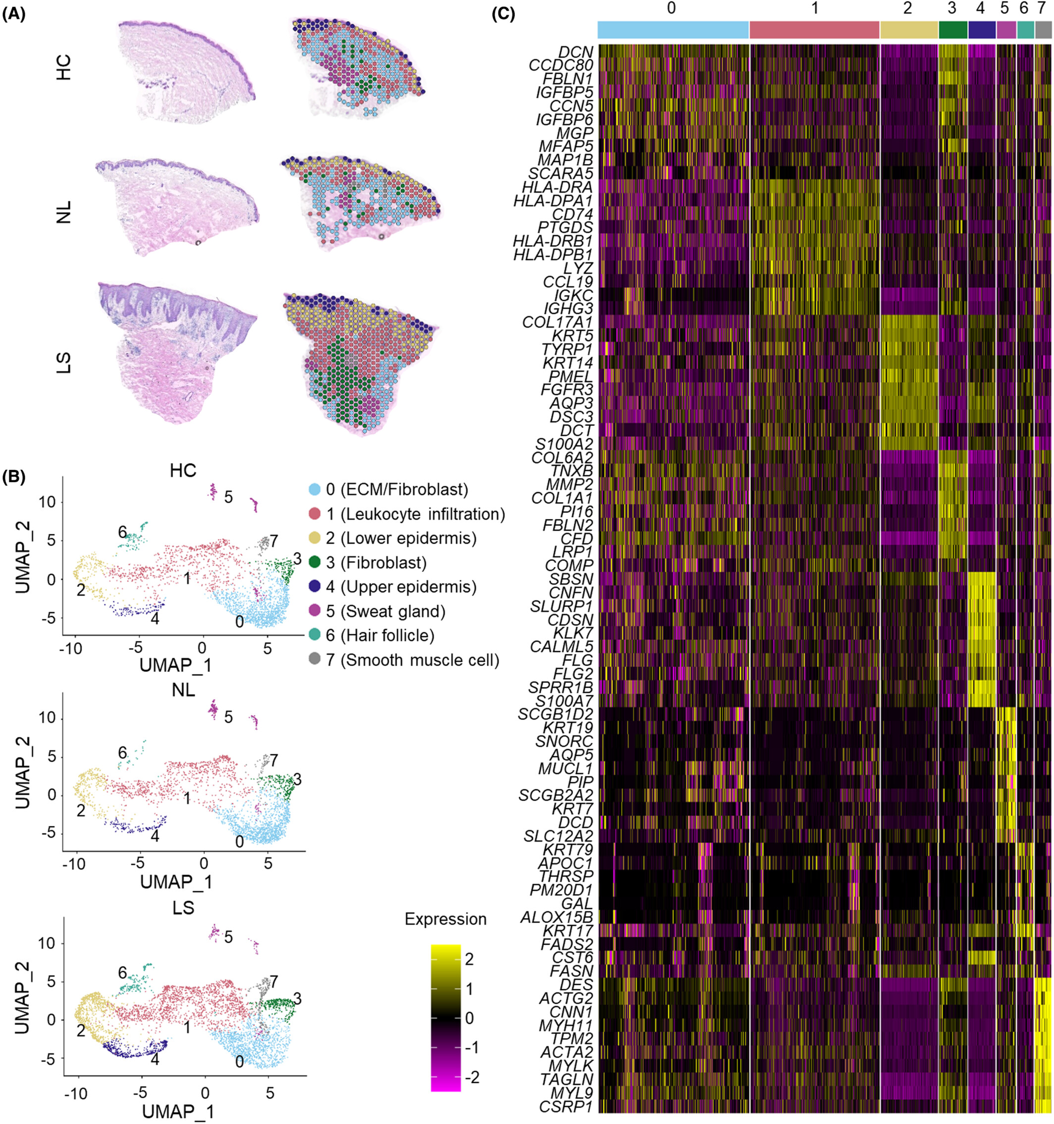Spatial transcriptomics combined with single-cell RNA-sequencing unravels the complex inflammatory cell network in atopic dermatitis [ST]