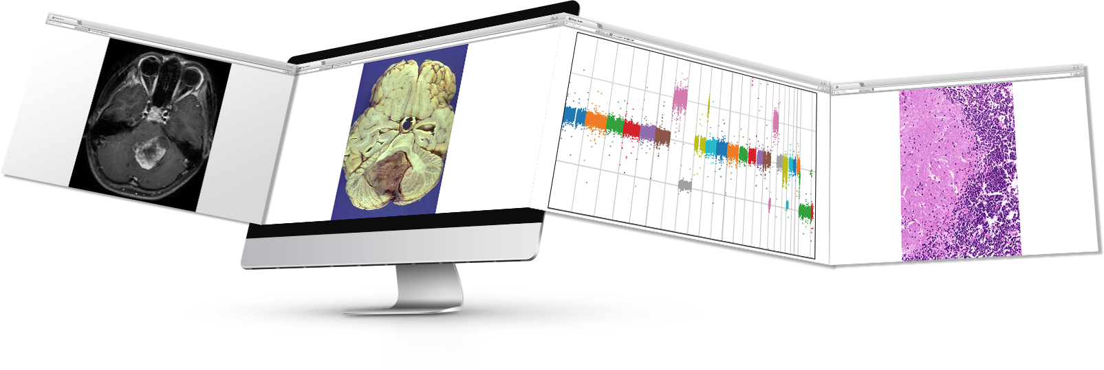 For Medulloblastoma (MB)